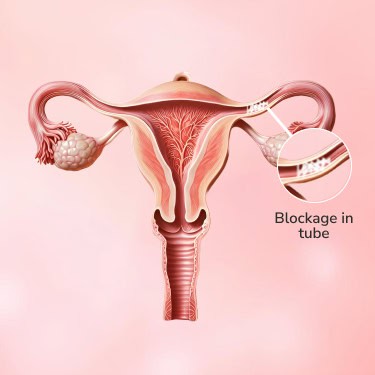 IUI –Intrauterine Insemination or Artificial Insemination (AI)